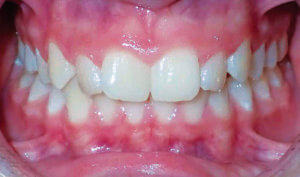 Before: Patient with overbite and crowding