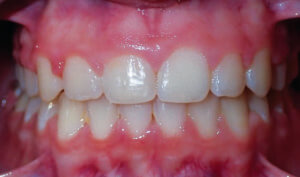 After: Patient with overbite and crowding
