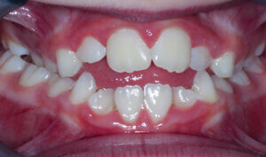 Before: Patient with crossbite and openbite