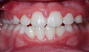 After: Patient with crossbite and openbite