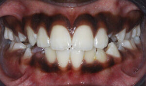 Before: Patient with protrusion