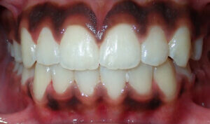 After: Patient with protrusion