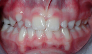 Before: Patient with crossbite
