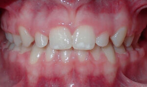 After: Patient with crossbite
