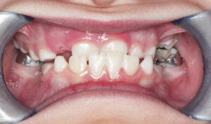 Before: Patient with crossbite