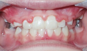After: Patient with crossbite