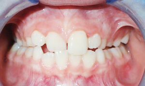 Before: Patient with crossbite