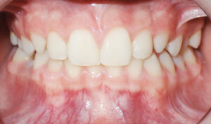 After: Patient with crossbite