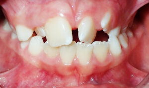 Before: Patient with crossbite