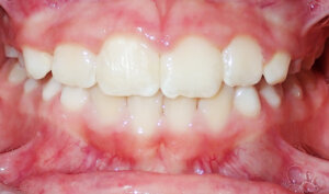 After: Patient with crossbite