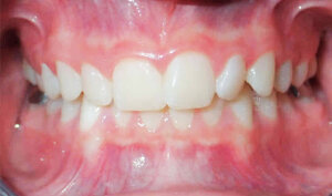 Before: Patient with overbite and crowding