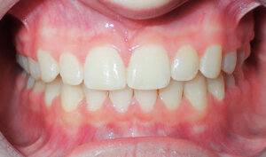 After: Patient with overbite and crowding